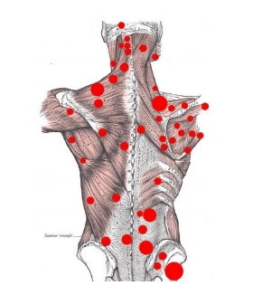 trigger points