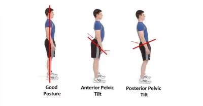 anterior vs posterior pelvic tilt