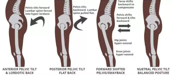 pelvic tilt and posture