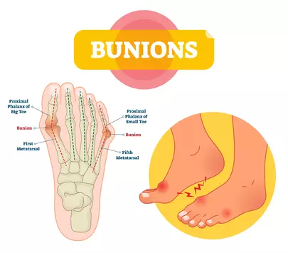 bunions definition