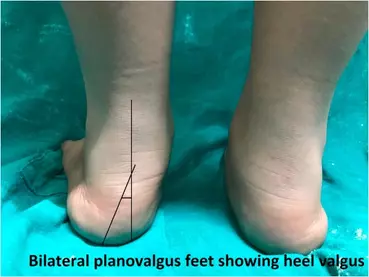 plano valgus hallux valgus