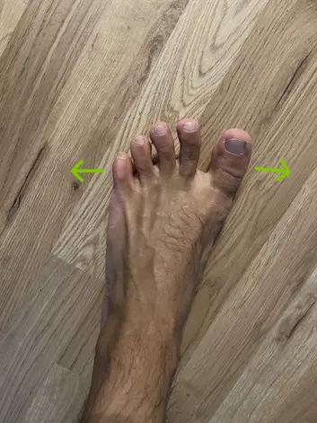 toes spread exercise for bunions