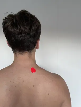 levator scapulae trigger points